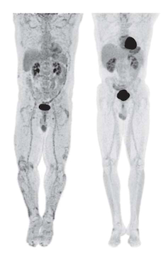 PET/CT Scan Showing Inflammation
