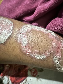 Psoriasis in my lower limb 