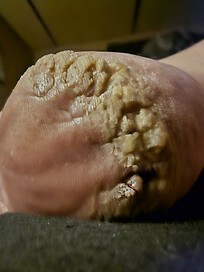 Possible psoriasis