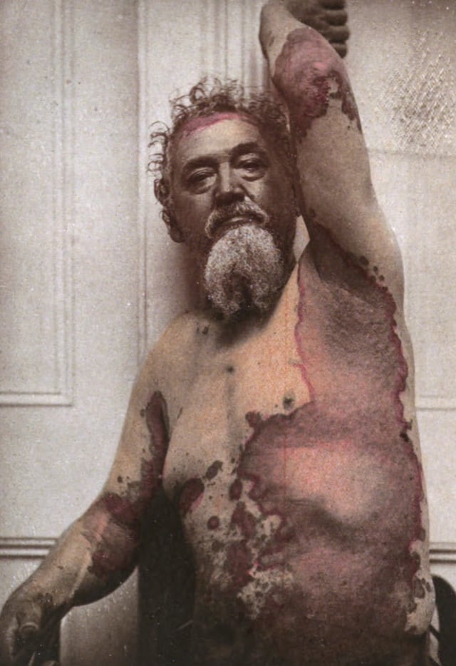 Older shirtless man displaying severe psoriasis on scalp, elbow, armpit, chest and stomach