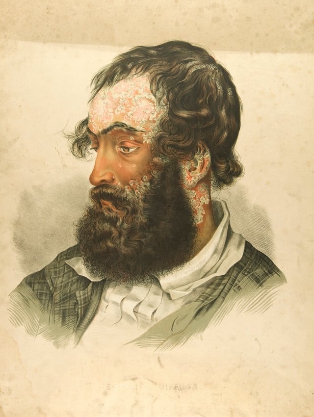 Man with beard looking sad with severe scalp and facial psoriasis
