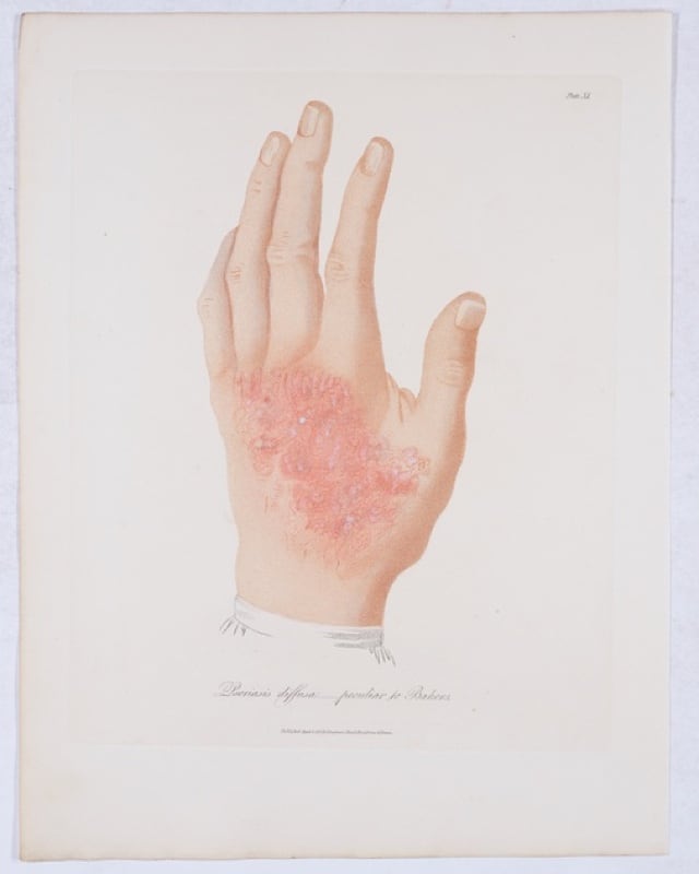 Severe psoriasis plaque displayed on back of a man's left hand