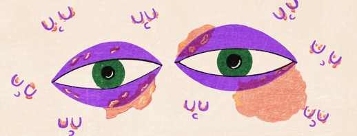 Debunking The Myth - Psoriasis On Your Eyelids image