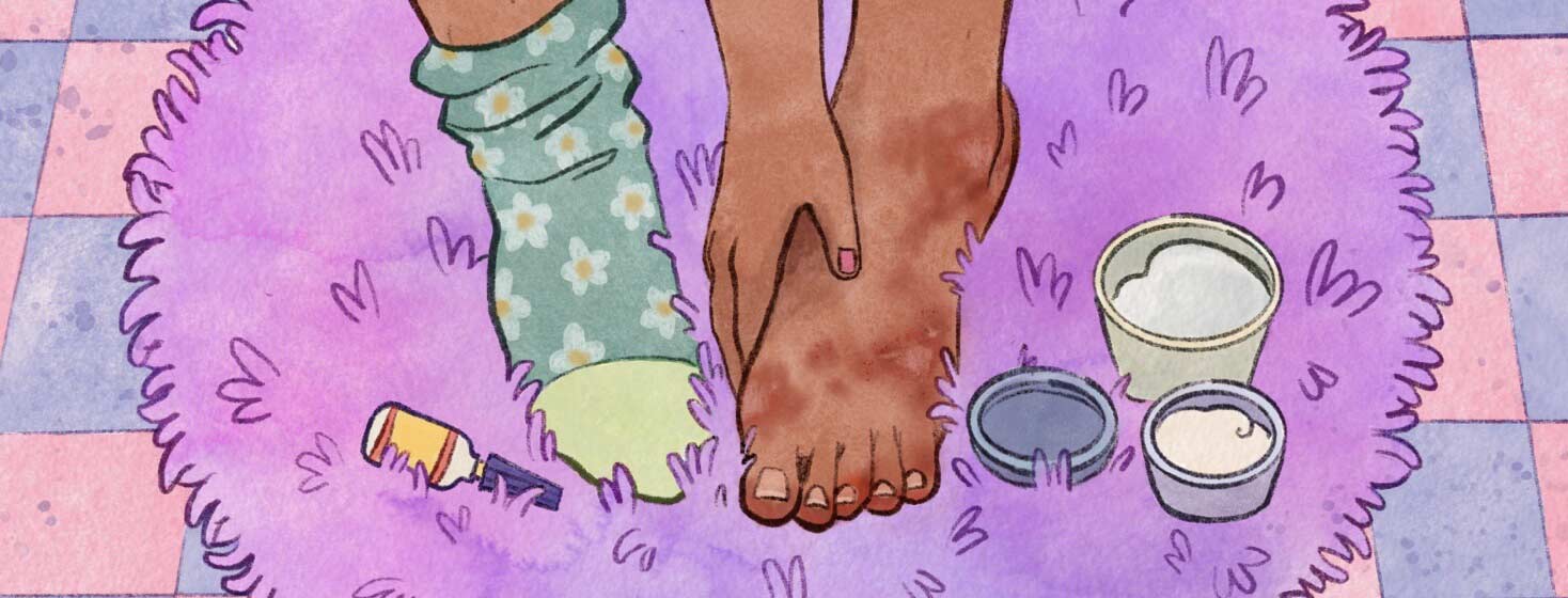 Adult female moisturizing her feet that have symptoms of psoriasis