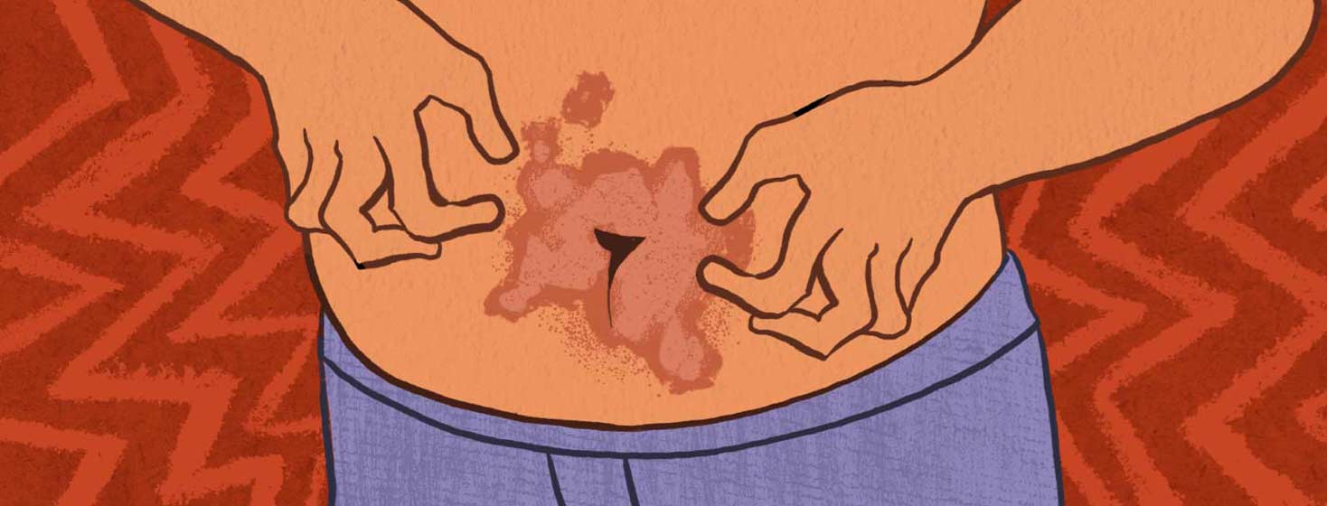 A stomach with plaques on the belly button. Two hands are about to scratch the area. Irritation.
