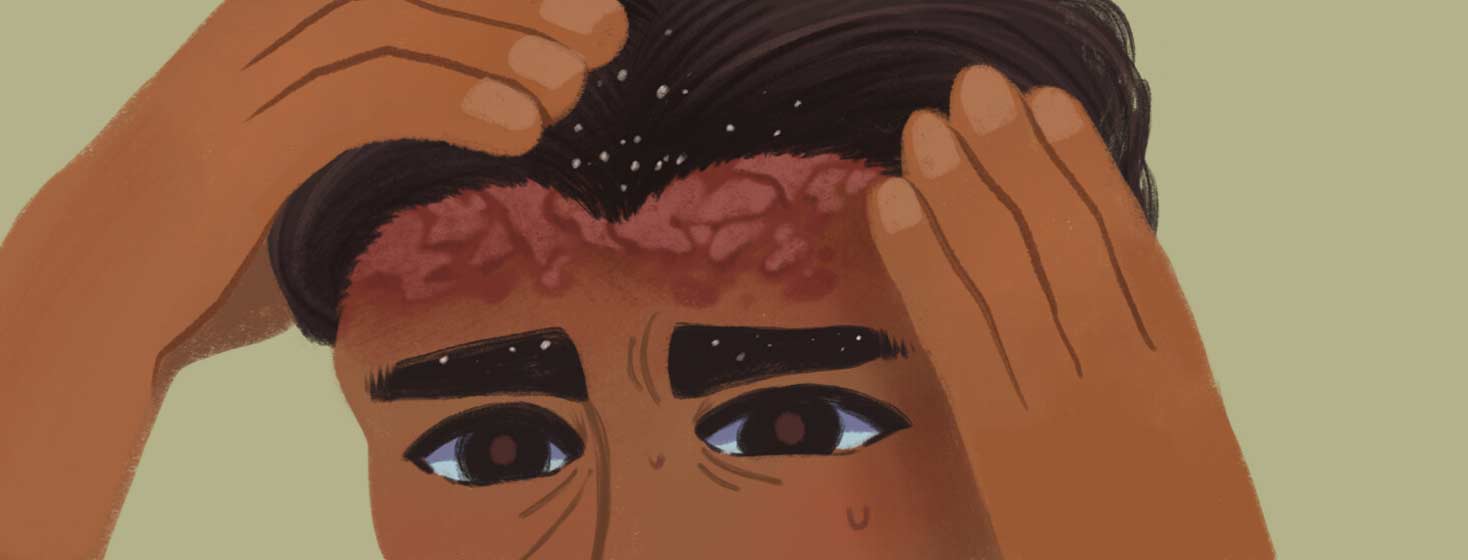 Adult male with hairline psoriasis plaques is inspecting his scalp to asses the situation. There are some white flakes in his eyebrows and hair due to the plaques. POC, latinx, skin condition