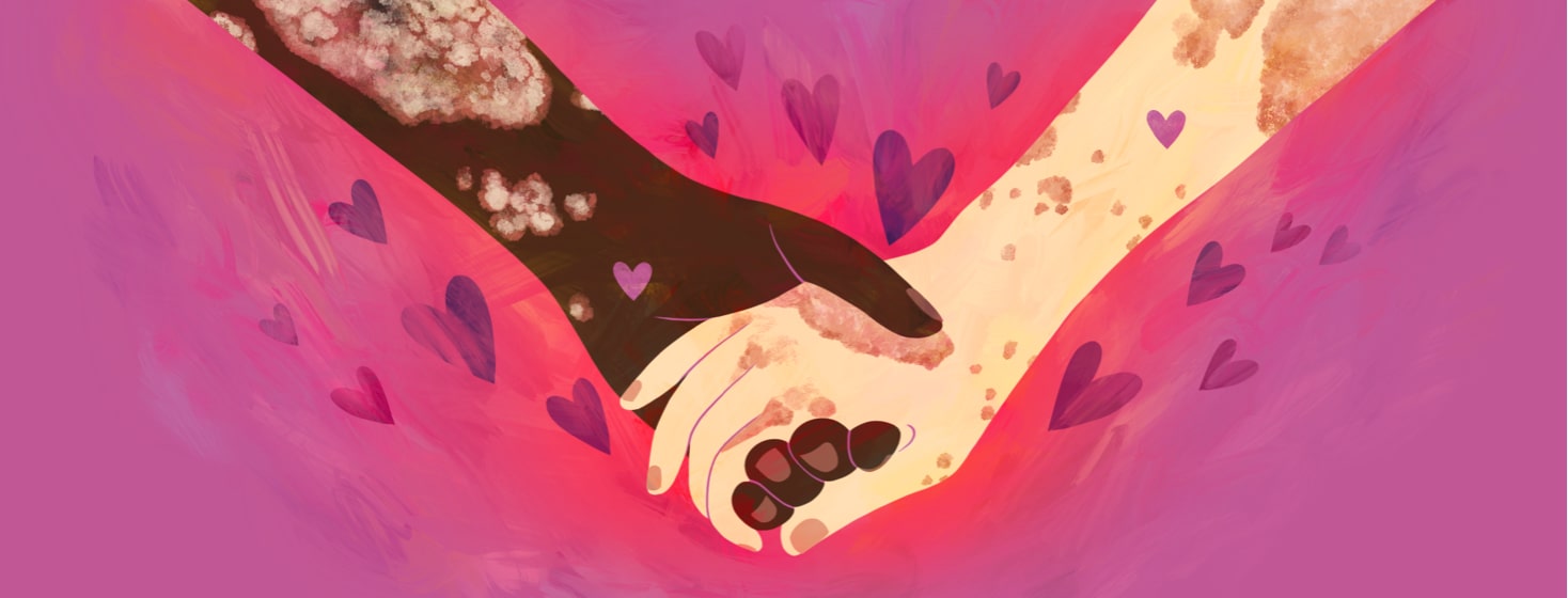 alt=holding hands, each with plaque psoriasis on the hands and arms with hearts floating around