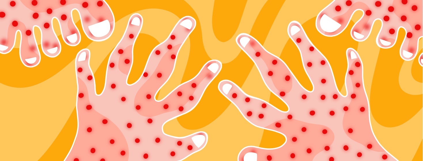Hands and feet with red dots signaling blisters all over them