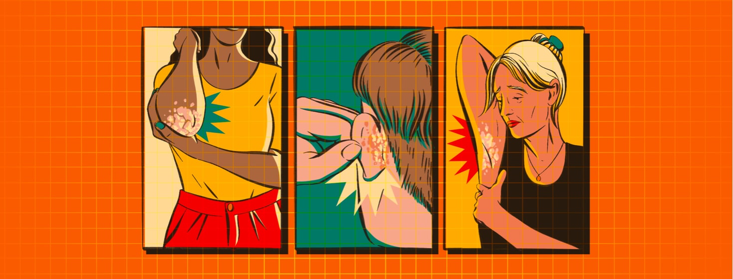 alt=three panels showing some of the worst areas for psoriasis