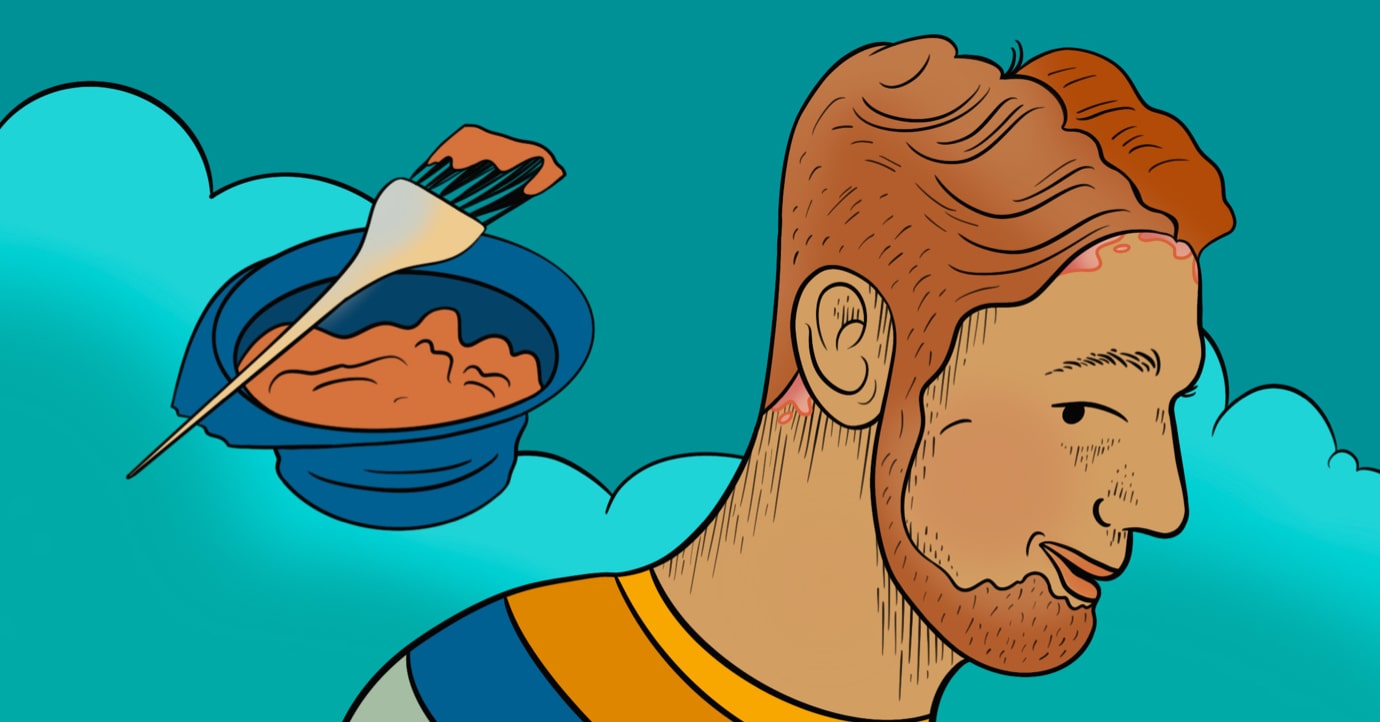 Hair Dye Tips For Those Who Live With Scalp Psoriasis